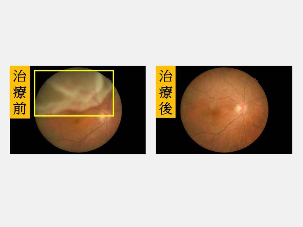 ▲【左圖】：治療前顯示視網膜剝離（方框處）；【右圖】：治療後顯示視網膜已貼合。（大里仁愛醫院）