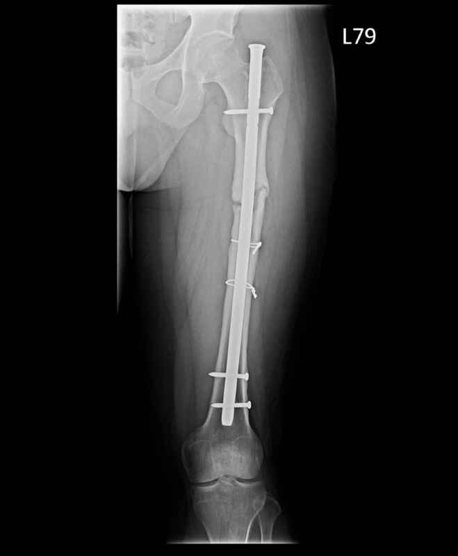 ▲患者於2014年車禍左股骨粉碎性骨折，打入鋼釘及固定螺絲，2016年時發現上方的固定螺絲已歪斜。（員榮醫院提供）