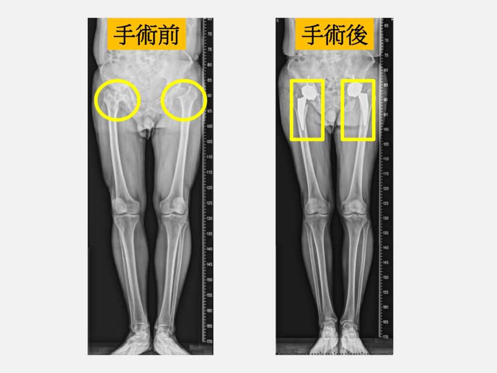 ▲病人雙側髖關節嚴重關節炎(左圖圓圈處),接受雙側微創人工髖關節置換手術回到正常生活(右圖方框處)。(大里仁愛醫院提供)