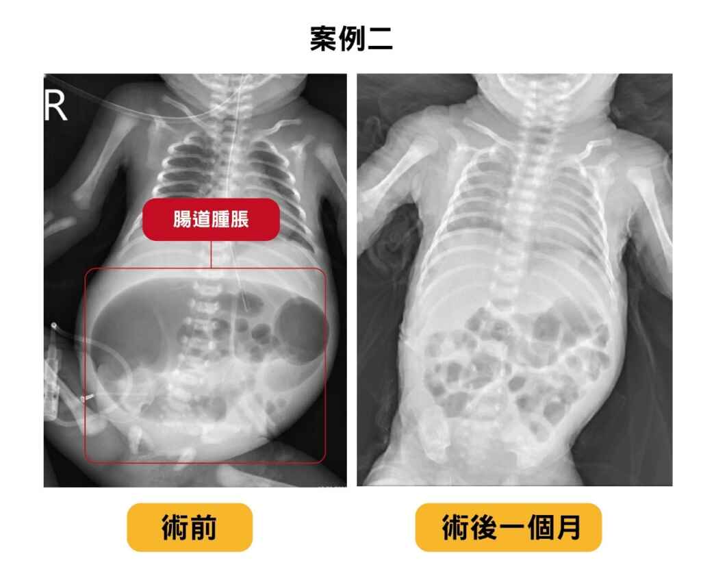 ▲嬰兒小亮是32歲媽媽懷孕30週時發現胎兒有水腫合併嚴重腹水,於第32週剖腹產出,出生時僅1700公克。經手術切除患部結構異常的25公分腸道,術後給予足夠營養支持。小亮於出生後一個月健康出院,體重已達到2300公克。(中醫大附醫提供)