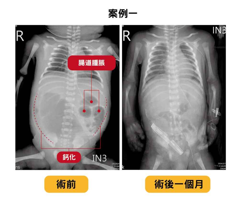 ▲嬰兒花花經中醫大附醫母嬰醫學中心跨專科照護治療後,術後一個月腹脹及鈣化明顯改善,並於出生三個月後順利健康出院。(中醫大附醫提供)