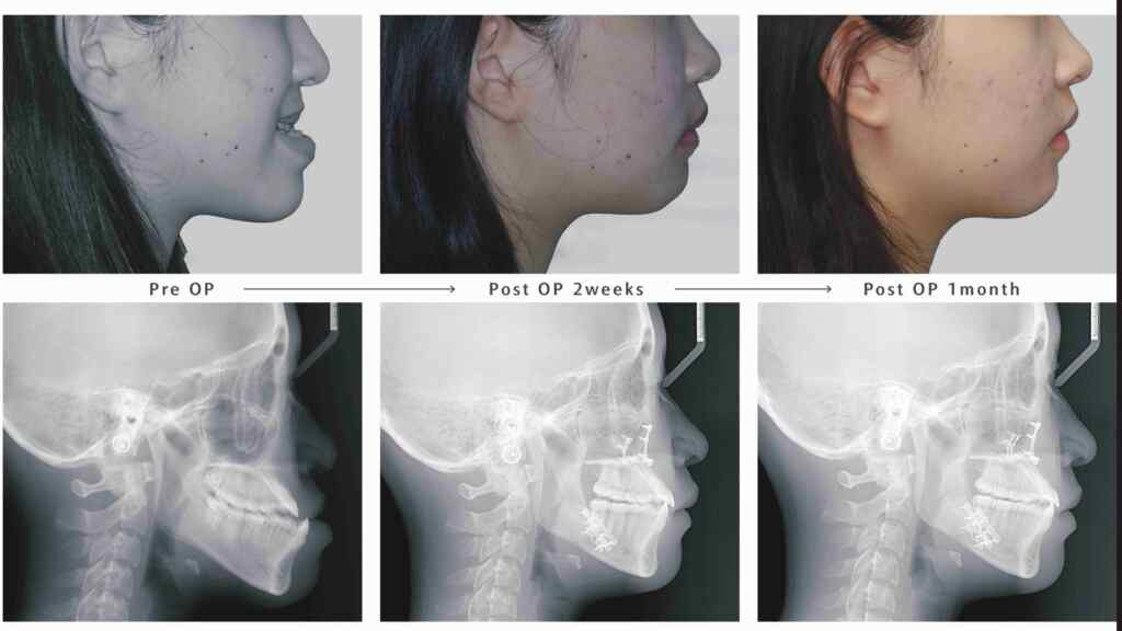 ▲小佳於術前、術後 2週及一個月的變化，可以看出輪廓變化及消腫情形。（彰基醫院提供）